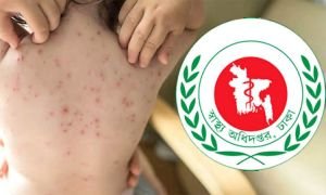 সিলেটে হামের উপসর্গ নিয়ে আরো ২ শিশুর মৃ/ত্যু