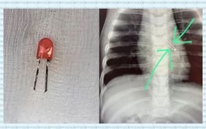 ৯ মাসের শিশুর ফুসফুস থেকে এলইডি বাল্ব অপসারণ