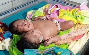 রাজশাহীতে দুই মাথা নিয়ে জন্ম নিল কন্যাশিশু